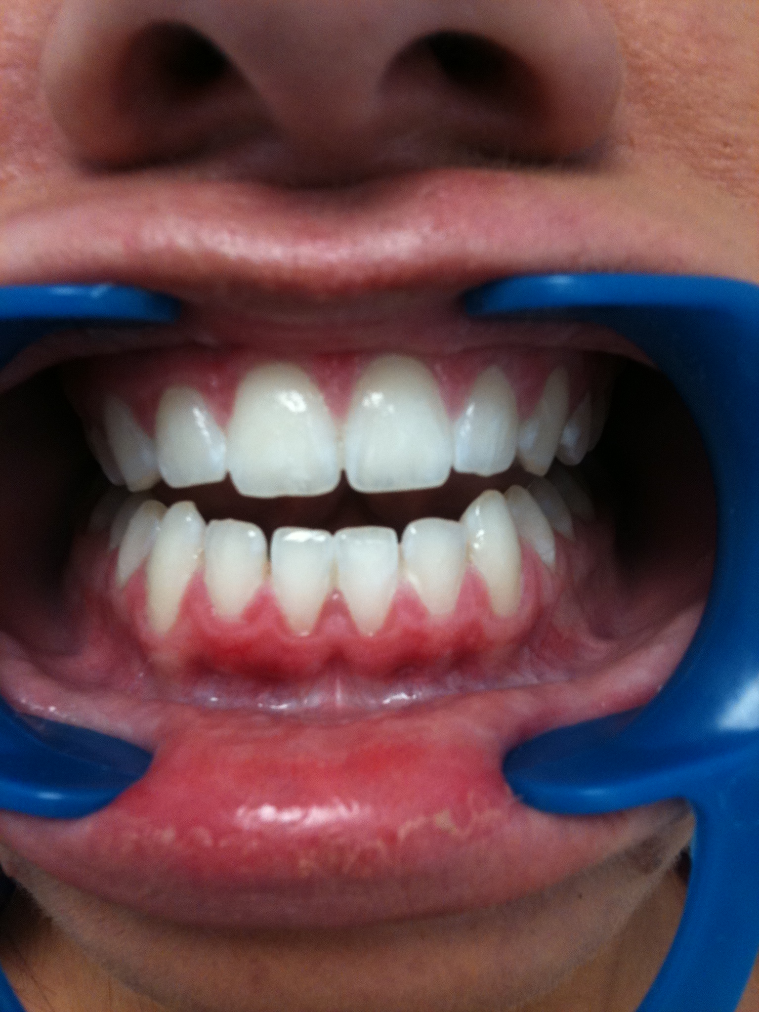 Laser teeth whitening reviews of Miami Smile in Windsor